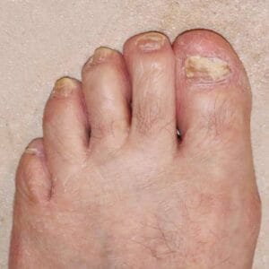 Fungal toe nails, how to treat fungal nails, how to cure nail fungus, best way to get rid of toenail fungus, best way to kill toenail fungus, best way to treat toenail fungus, fungus under toenails