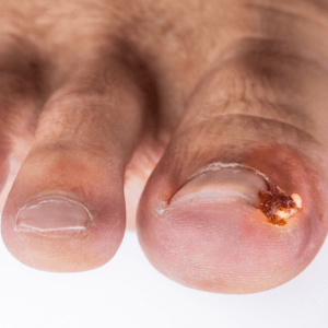 An infected ingrowing toenail, how to treat ingrown toenails, how to treat ingrown toenails, toenail care, toenail infection treatment